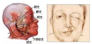 面部肌肉抽搐与眼皮跳动