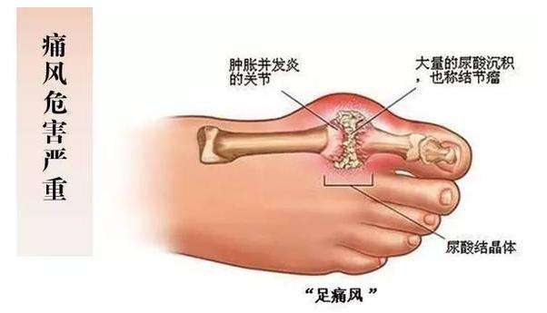 健康之路痛风Zui爱找上谁,健康之路痛风