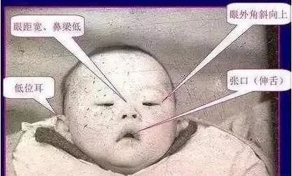 1. 明白唐氏征的特殊性