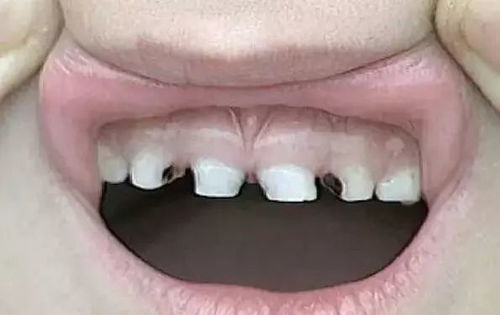 梦见牙齿断了留下牙根和牙齿松动，整口牙齿松动还掉了一个，这是怎么回事？