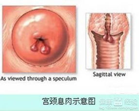 3. 子宫肌瘤/内膜炎/宫颈息肉——妇科病的终极BOSS
