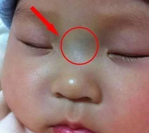胎记看吉凶：龙纹、虎纹…
