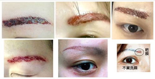 眉毛内疤痕如何彻底去除不留痕迹？