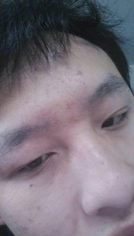 额头发黑是黑色素过多，吃哪种药物可以改善？