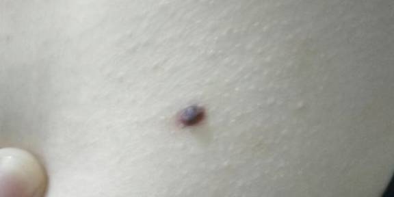 身上长疙瘩与风水有关联吗？