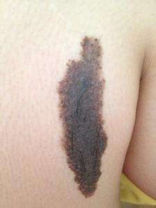 脖子后面的胎记：前世是吸血鬼？