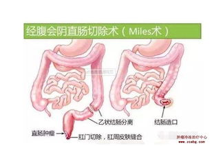 四、手术干预：最后再来看一招