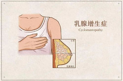 先别慌！乳腺增生到底是个啥玩意儿？