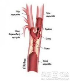 颈动脉堵塞算大病吗,颈动脉堵塞会引起什么样的结果