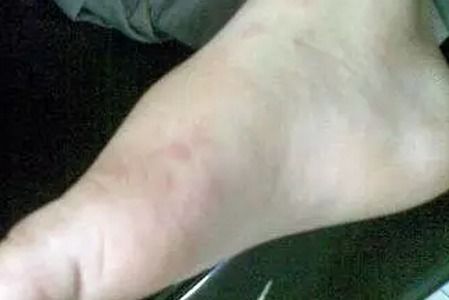 梦见手被别人咬出血了是什么预兆？