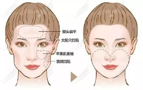 脸颊凹陷用玻尿酸填充好吗,脸颊凹陷是肾气不足