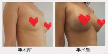 10月做隆胸手术，腋窝切口适合我吗？哪天是吉日？