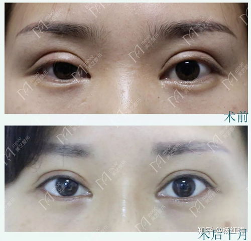 割双眼皮对风水有影响吗？忒别是肉眼泡割双眼皮？