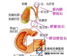 胆管结石风水问题严重吗，会对日常生活和健康造成哪些影响？