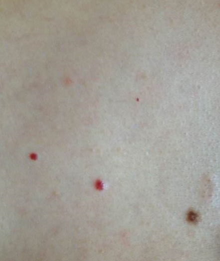 紫微星的神秘面纱：胎记之谜