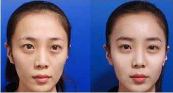 真实案例：天庭饱满的人有多惨