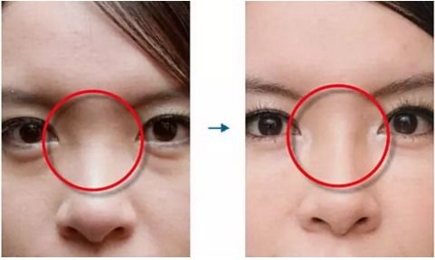 玻尿酸填鼻子风水,玻尿酸填鼻子风水