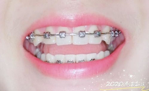 梦见自己戴牙套矫正牙齿是什么预兆？